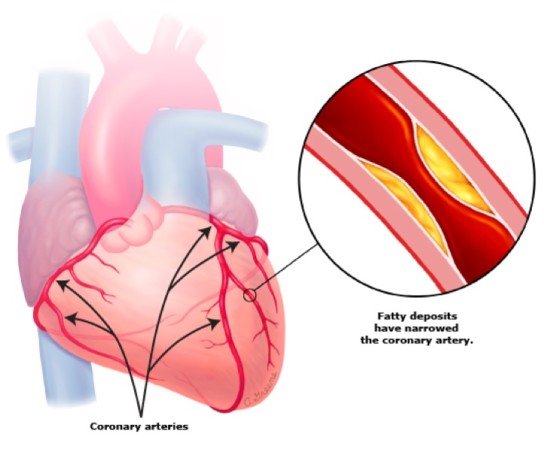 coronary artery disease a macrovascular complication