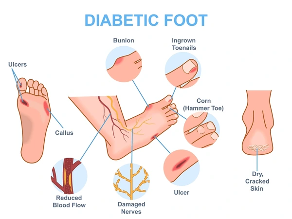 diabetic foot medical diagram infographics 600nw 2388798505