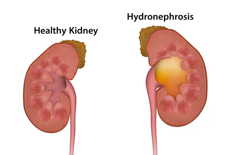 hydronephrosis kidney