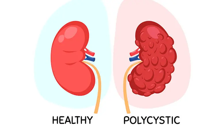 polycystic kidney
