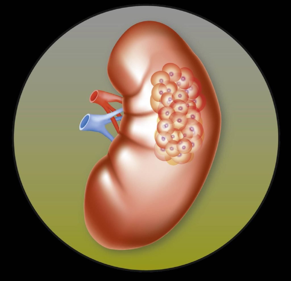 prcc kidney