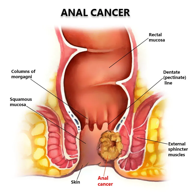 anal cancer