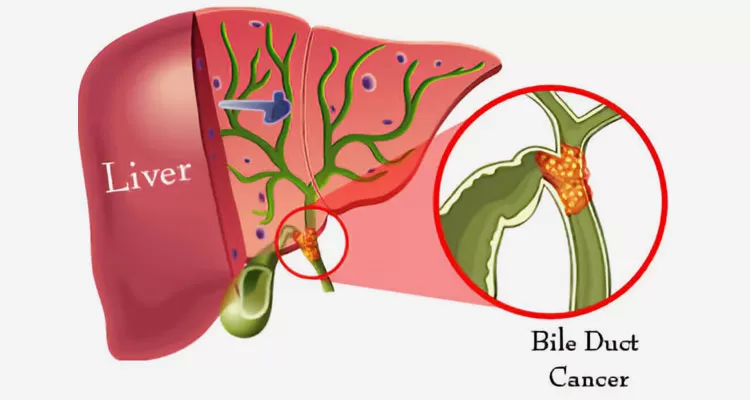 cholangiocarcinoma (bile duct cancer)