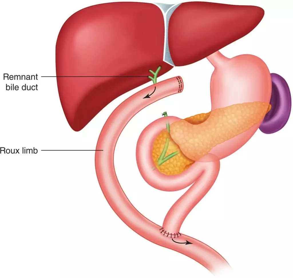 choledochal cysts (bile duct cysts)