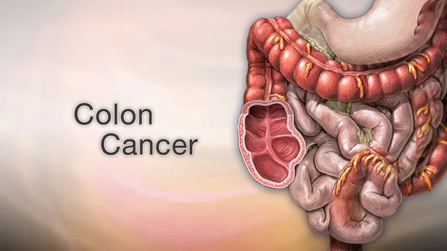 colon cancer (large intestine cancer)