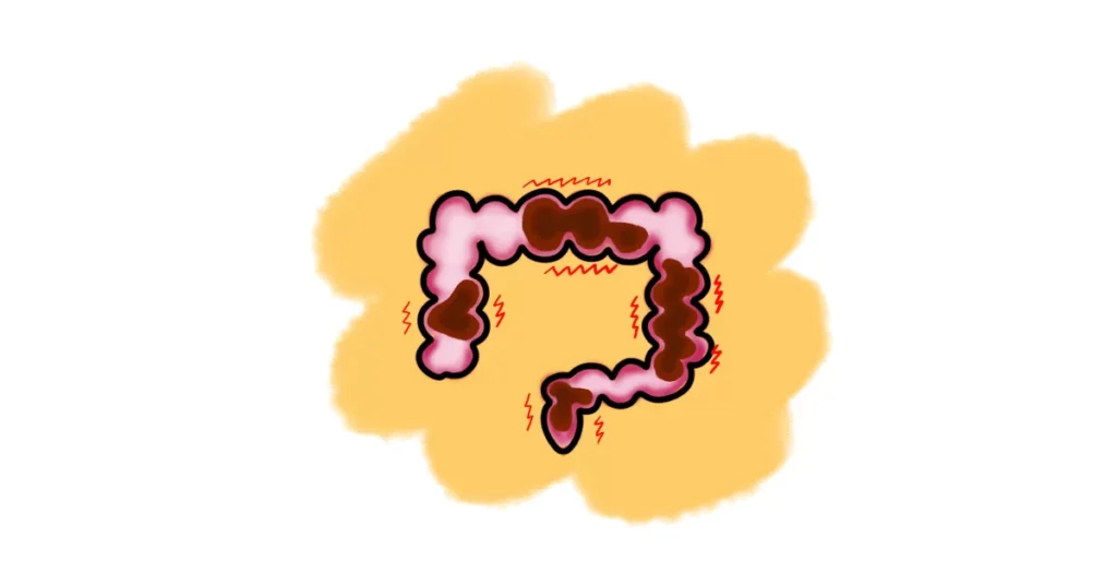 Normal Transit Constipation (Functional Constipation)