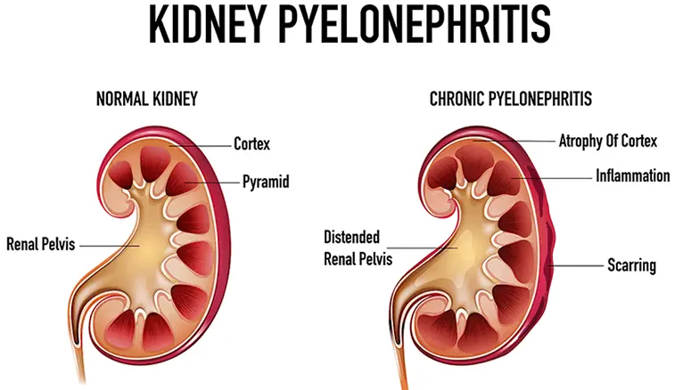pyelonephritis (kidney infection)