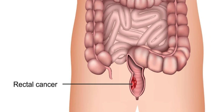 rectal cancer