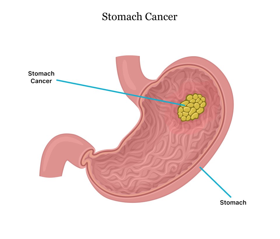 stomach (gastric) cancer