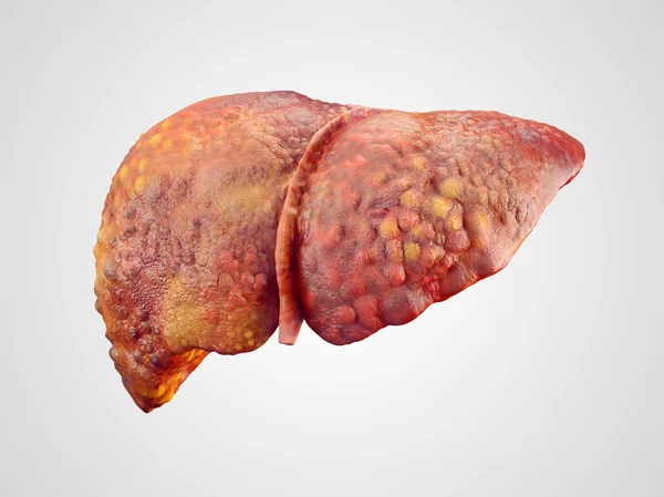 chronic liver