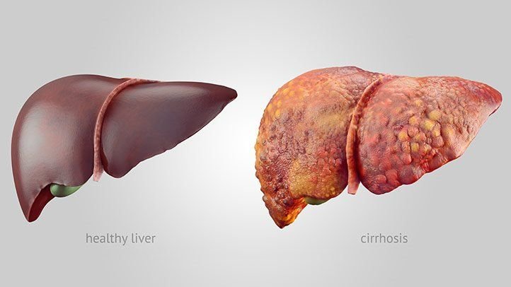 cirrhosis liver