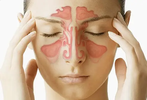 Acute Sinusitis