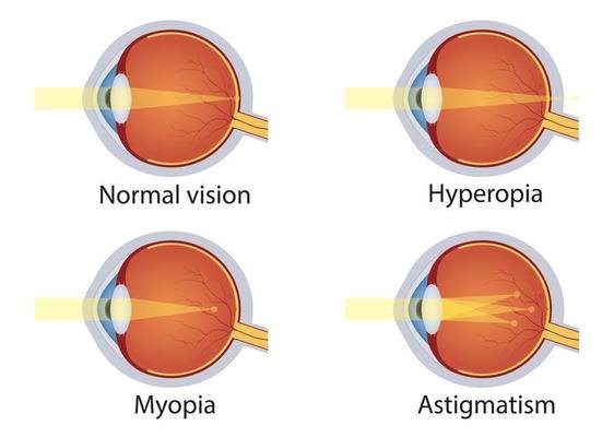 Astigmatism