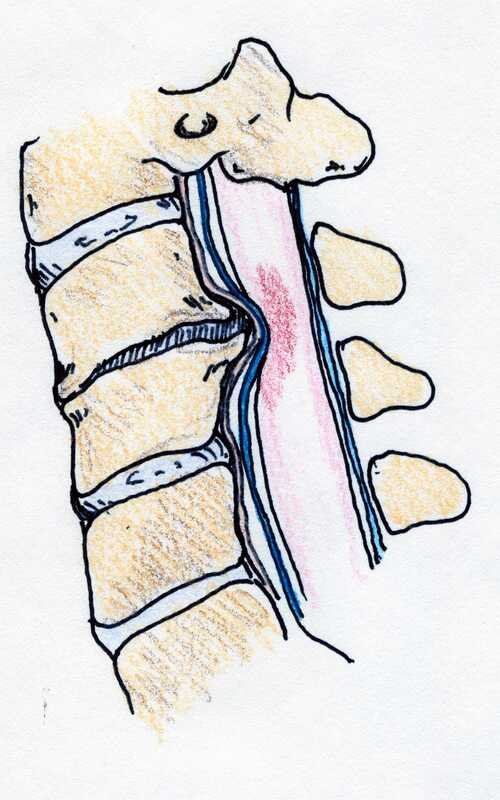 Cervical Myelopathy