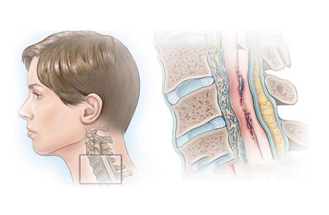 Cervical Spondylotic Myelopathy