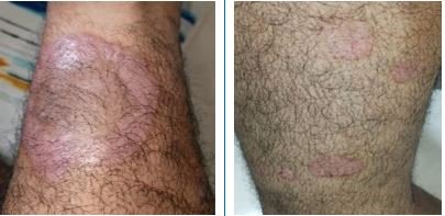 Erythrodermic Psoriasis