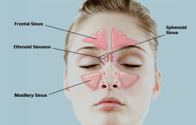 Frontal Sinusitis