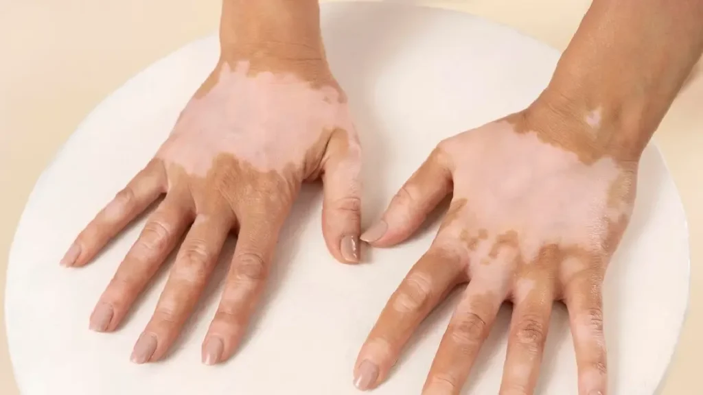 Generalized Vitiligo