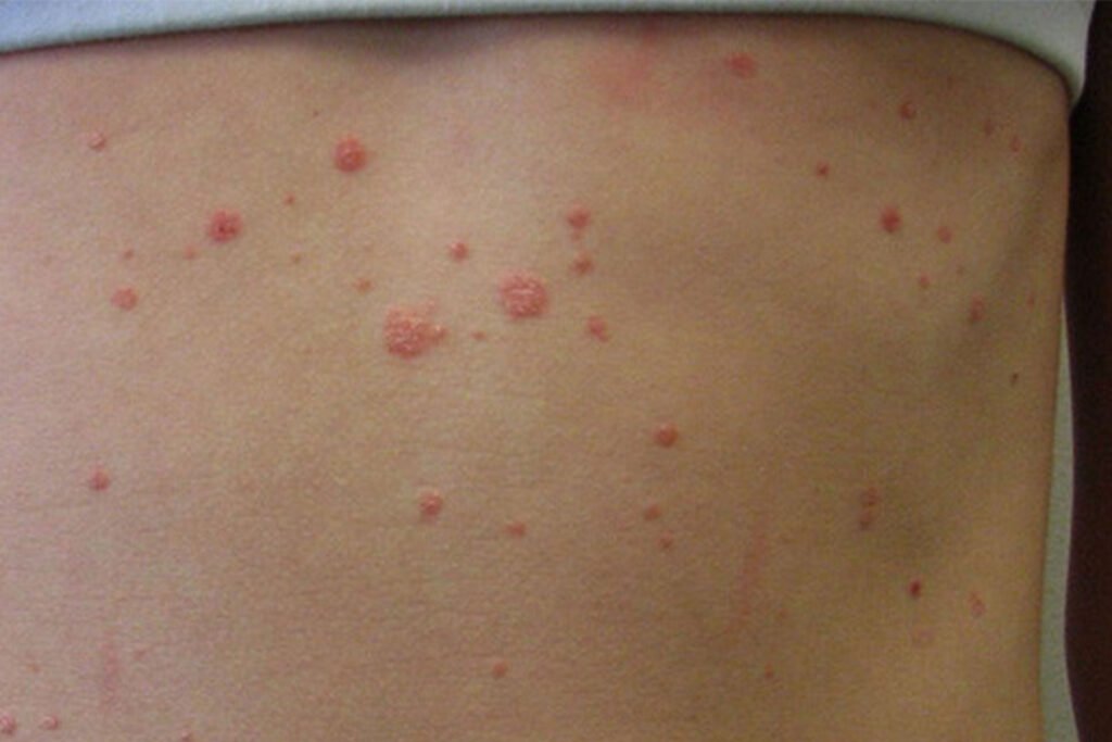 Guttate Psoriasis