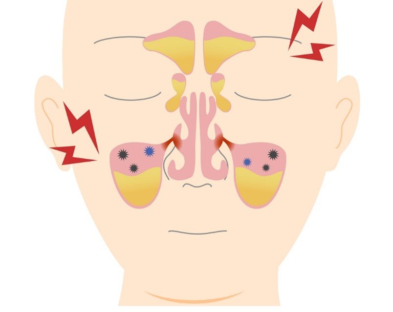 Maxillary Sinusitis