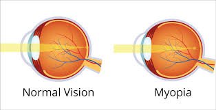 Myopia (Nearsightedness)