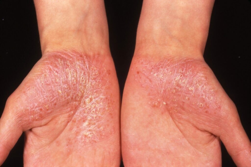 Pustular Psoriasis