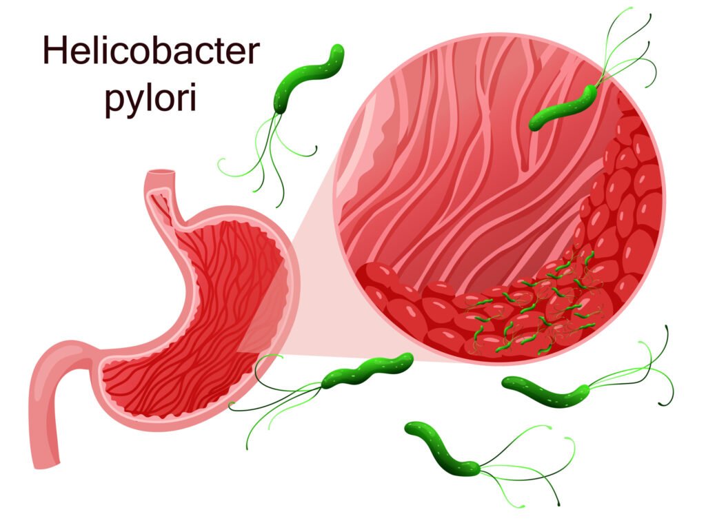 Type B – H. Pylori Associated Chronic Gastritis