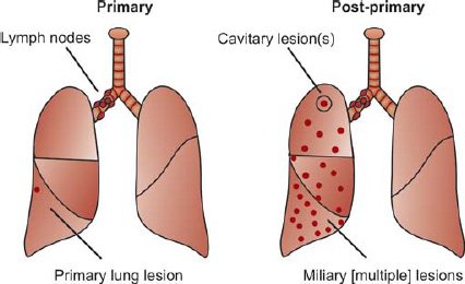 Post-Primary Pulmonary Tuberculosis (Reactivation TB)