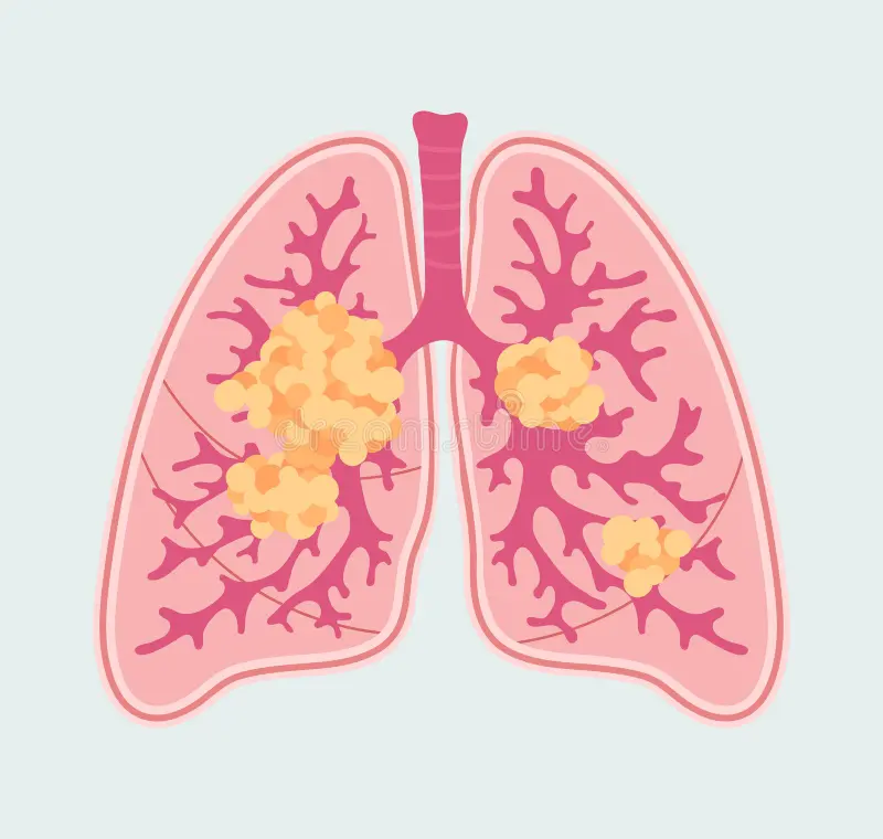 Primary Pulmonary Tuberculosis